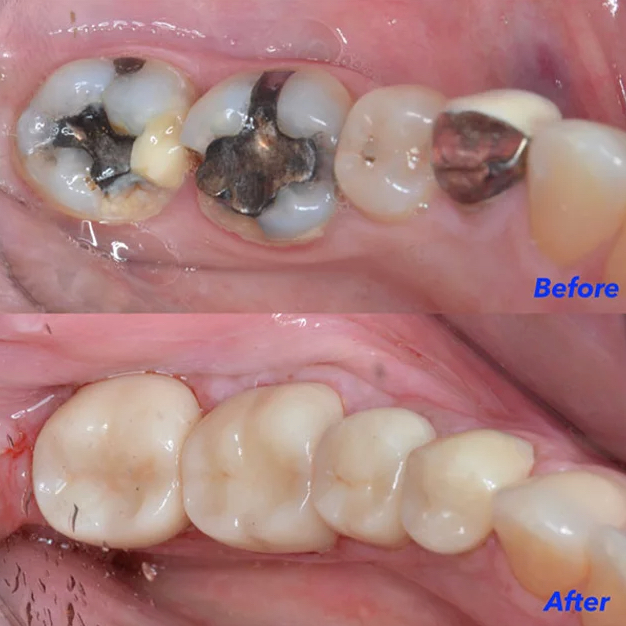 Before and after views of posterior teeth, showing the replacement of old silver amalgam fillings with tooth-colored composite restorations