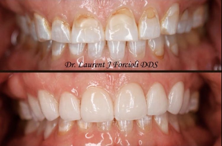 Before and after comparison showing the transition from stained, uneven teeth to a bright, symmetrical smile with veneers.