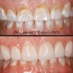 Before and after comparison showing the transition from stained, uneven teeth to a bright, symmetrical smile with veneers.