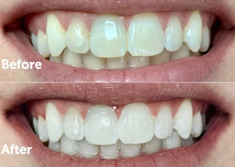 Before and after close-up of a patient's smile following professional teeth whitening treatment, showing a significantly brighter and whiter shade