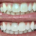 Before and after close-up of a patient's smile following professional teeth whitening treatment, showing a significantly brighter and whiter shade