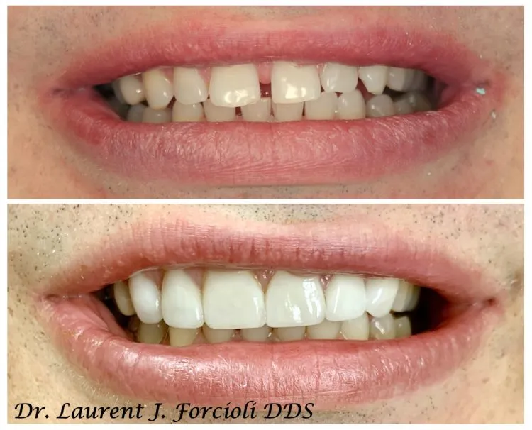 Before and after close-up of a patient's smile, showing the correction of a gap between the front teeth (diastema)