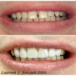 Before and after close-up of a patient's smile, showing the correction of a gap between the front teeth (diastema)