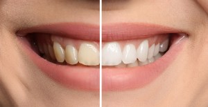 teeth whitening before and after lombard il