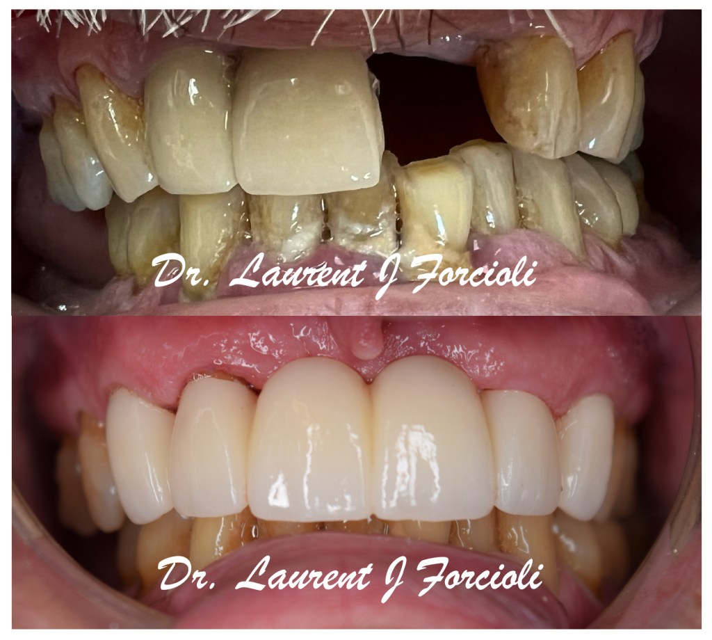Before and after comparison of a full upper arch restoration, showing the replacement of missing and damaged teeth with a permanent dental bridge