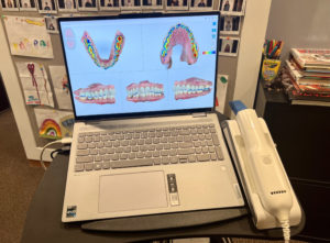 Itero Dental Scanner Machine