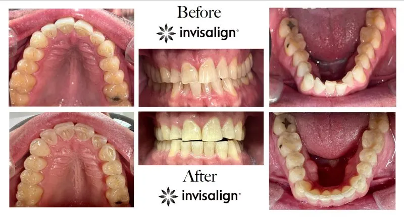 Invisalign result collage showing the successful straightening of moderate crowding in both the upper and lower jaws