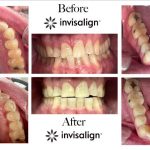 Detailed Invisalign progress shots illustrating the expansion of a narrow upper arch and straightening of crowded lower teeth