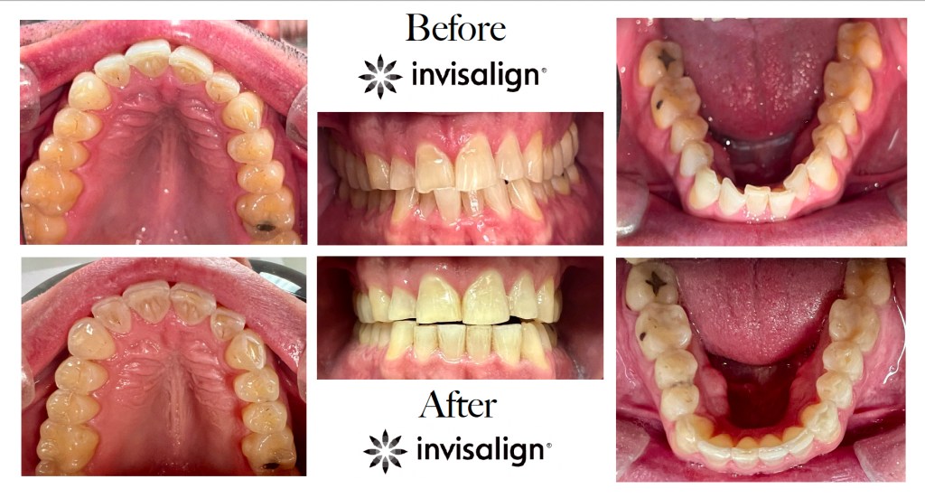 real Invisalign patient from Dr. Forcioli