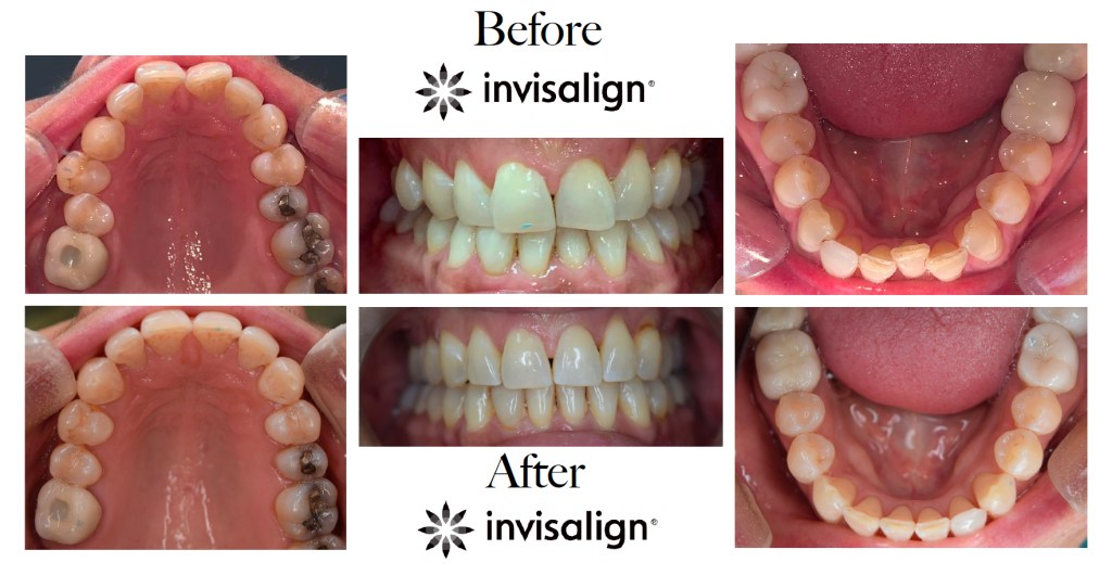 Invisalign case study display showing upper arch, lower arch, and frontal views before and after clear aligner treatment
