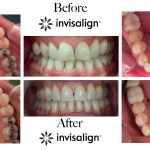 Invisalign case study display showing upper arch, lower arch, and frontal views before and after clear aligner treatment
