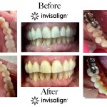 Orthodontic results showing the transformation of an uneven bite into a perfectly aligned and level dental arch