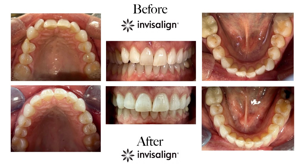 Before and after views of a wide upper arch and lower arch, highlighting the closure of spacing between molars