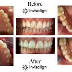Before and after views of a wide upper arch and lower arch, highlighting the closure of spacing between molars