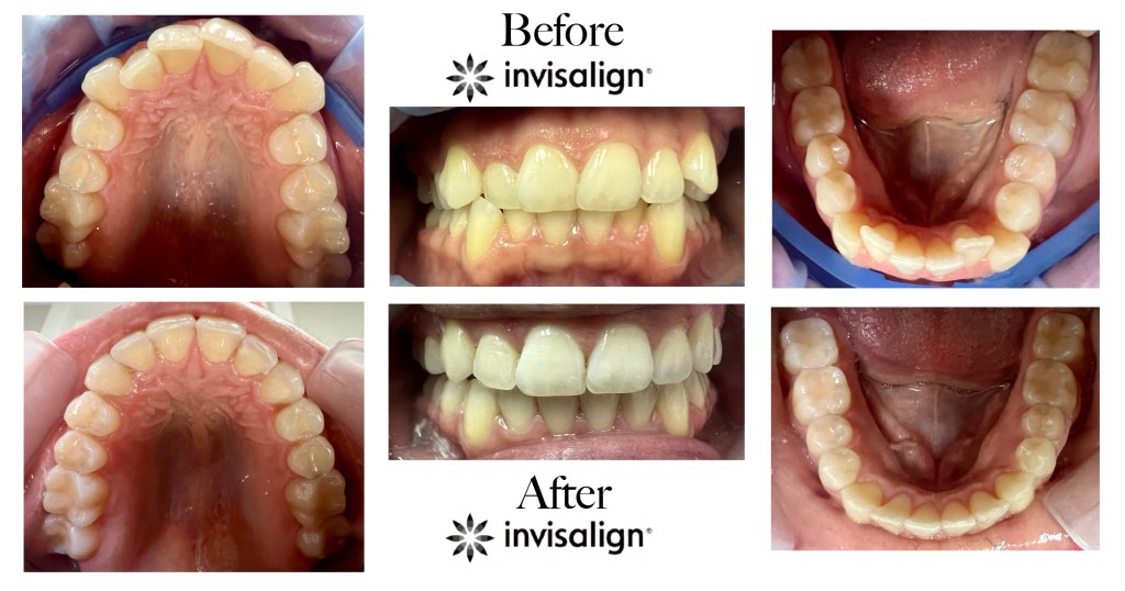 Invisalign progress photos showcasing the alignment of the front teeth and correction of the arch shape