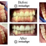 Invisalign progress photos showcasing the alignment of the front teeth and correction of the arch shape