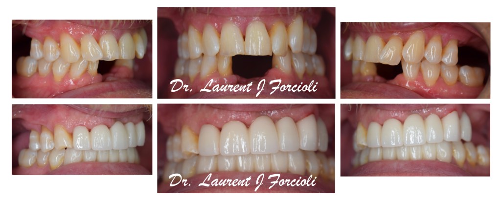 Multi-angle before and after comparison showing the replacement of a missing front tooth with a dental bridge or implan