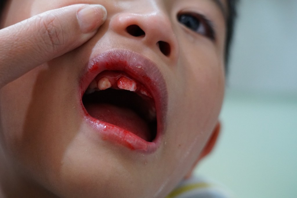 gum lips bleeding out asian boy